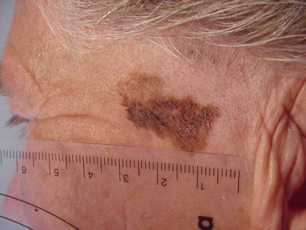 tumori kože