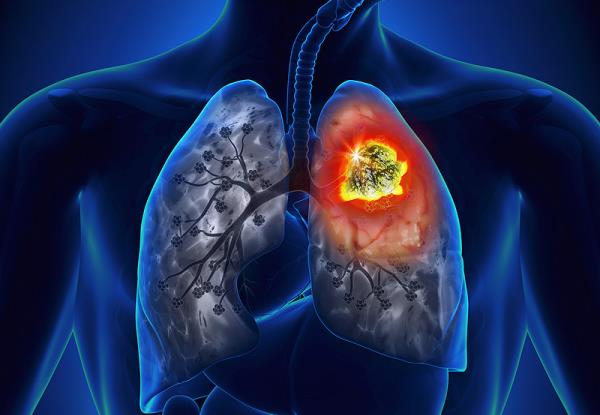 Microcellular lung cancer