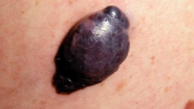 Nodular melanoma cancer