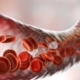 anemia anemia image