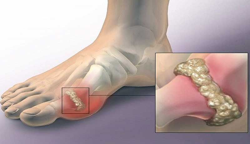 gout inflammation of the joint