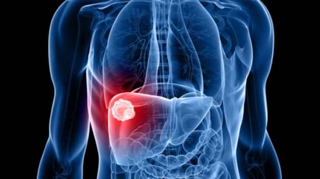 hepatocelularni karcinom malignitet jetre