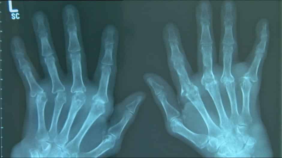 Röntgenaufnahme von Rheuma