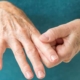 reumatoidni artritis glavna slika