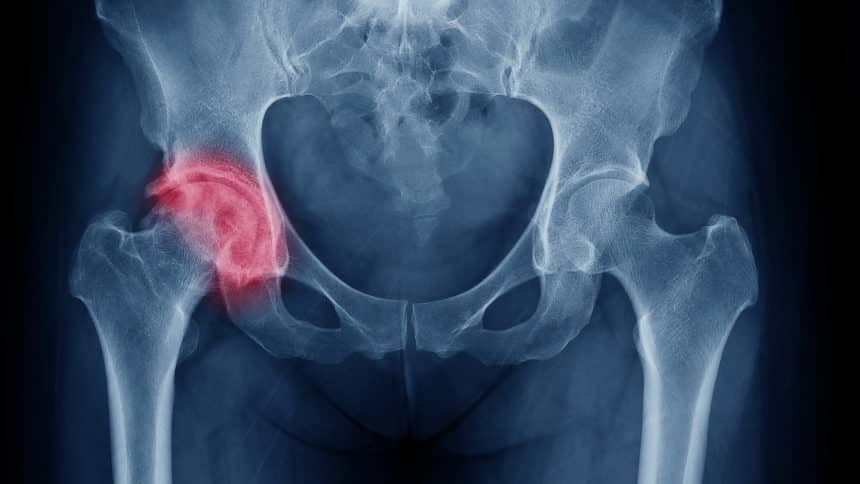 Osteoartritis treba shvatiti ozbiljno: naučite prepoznati simptome