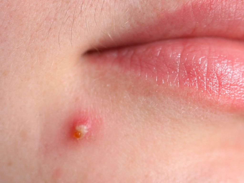 picture of acne
