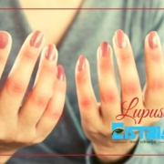 lupus disease major