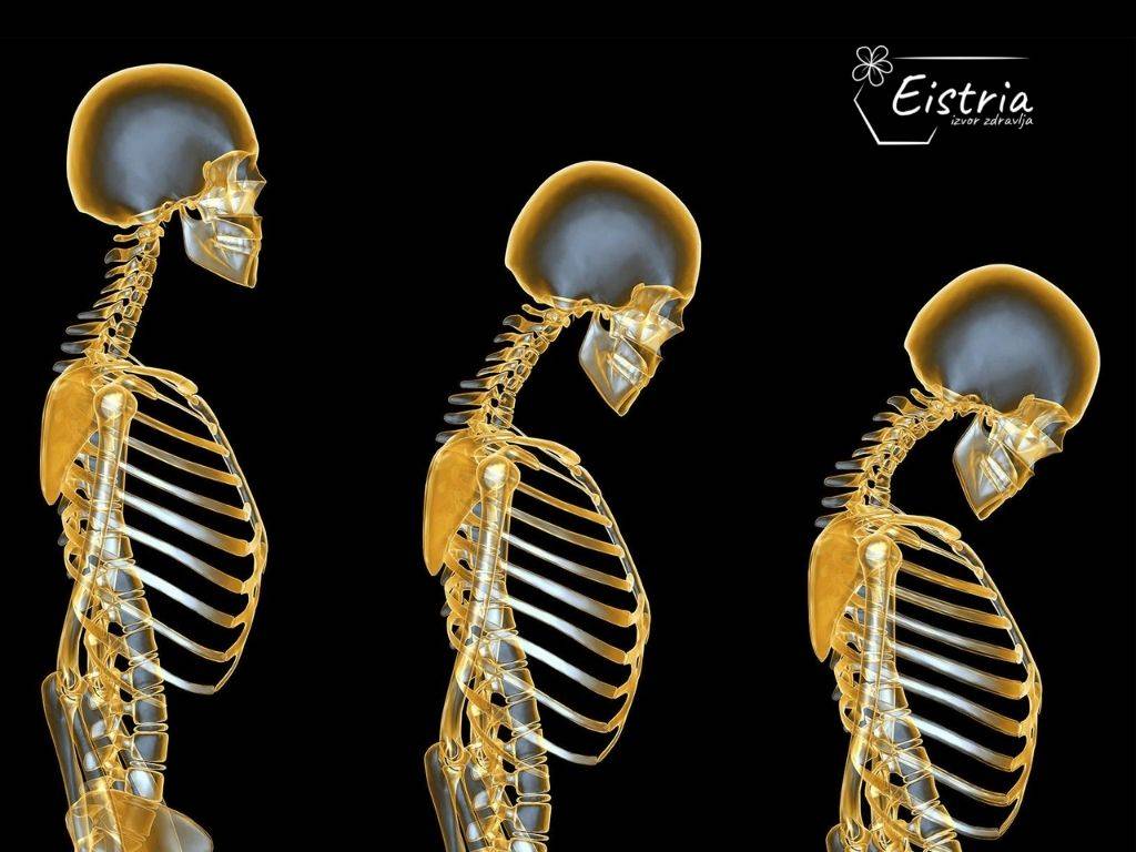علاج هشاشة العظام بشكل طبيعي