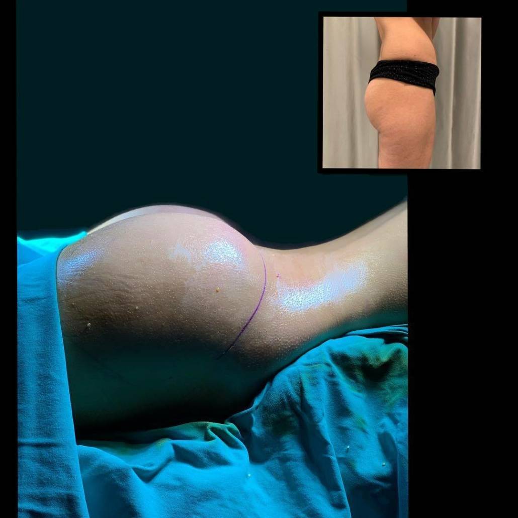 buttock lifting surgery 