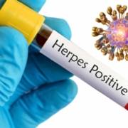 herpes virus i prirodno lečenje