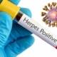 herpes virus i prirodno lečenje