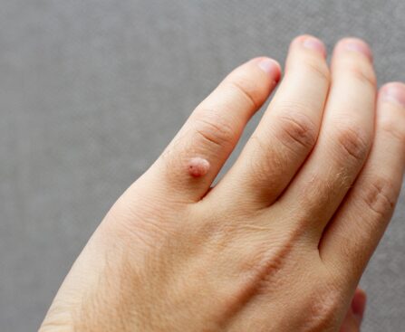 finger wart on hand. health concept. body wart